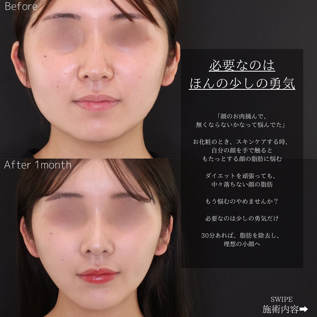 バッカルファット除去/ジョールファット除去/顎下の脂肪吸引の症例写真 施術前後 