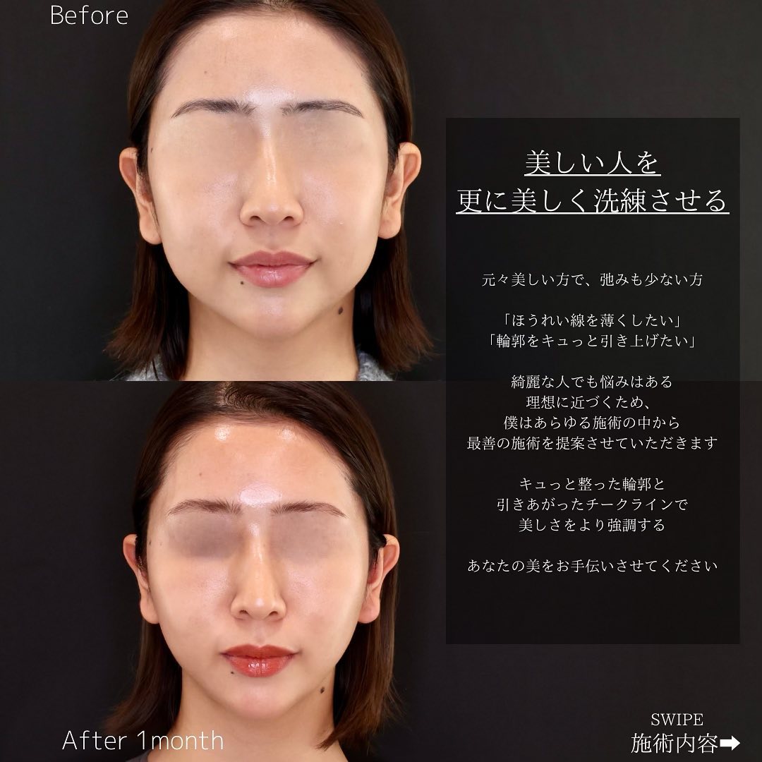 TAC式 ツヤ肌コラーゲンリフト®の症例写真 施術前後 