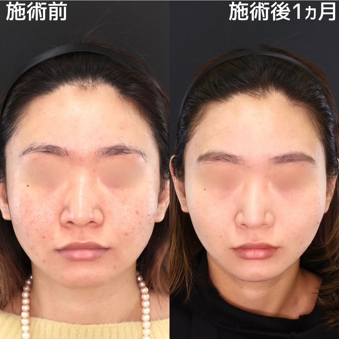 小顔で垢抜け！すっきりとしたフェイスラインに