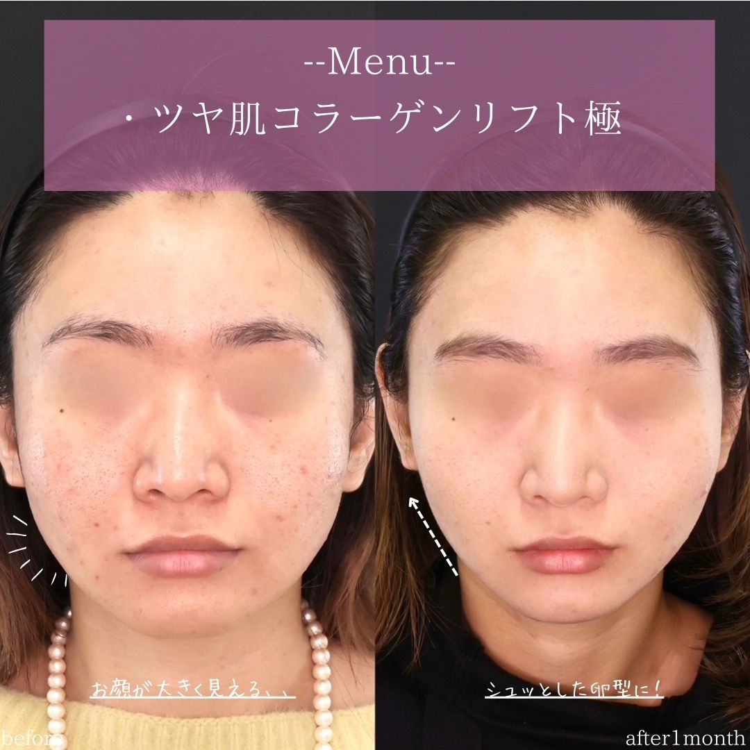 TAC式 ツヤ肌コラーゲンリフト®の症例写真 施術前後 