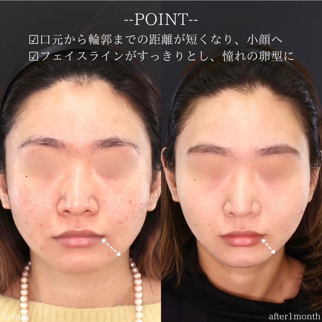 TAC式 ツヤ肌コラーゲンリフト®の症例写真 施術前後 