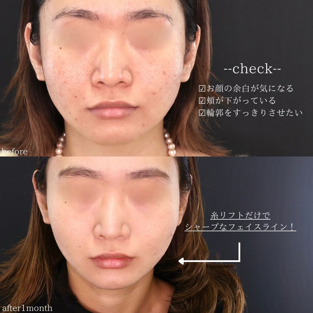 TAC式 ツヤ肌コラーゲンリフト®の症例写真 施術前後 