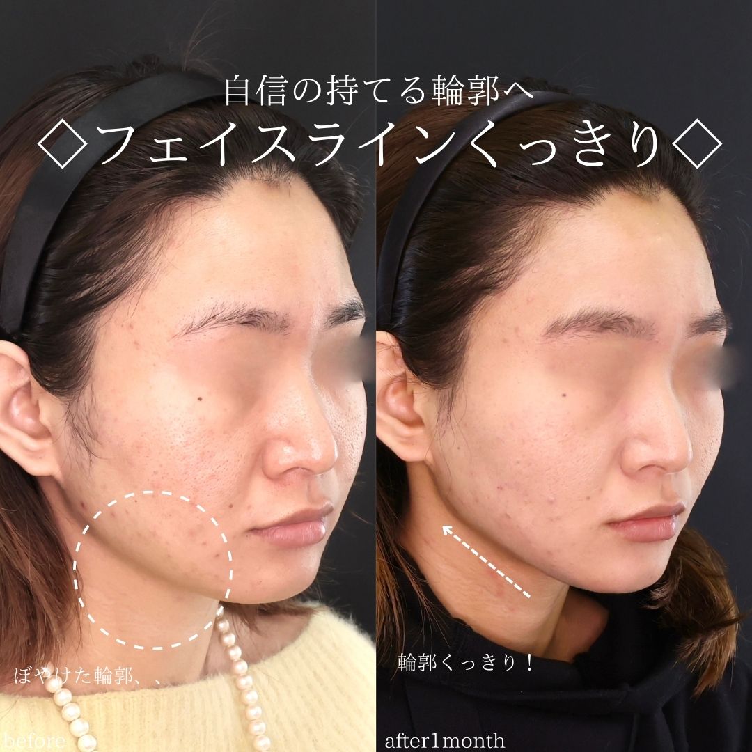 TAC式 ツヤ肌コラーゲンリフト®の症例写真 施術前後 