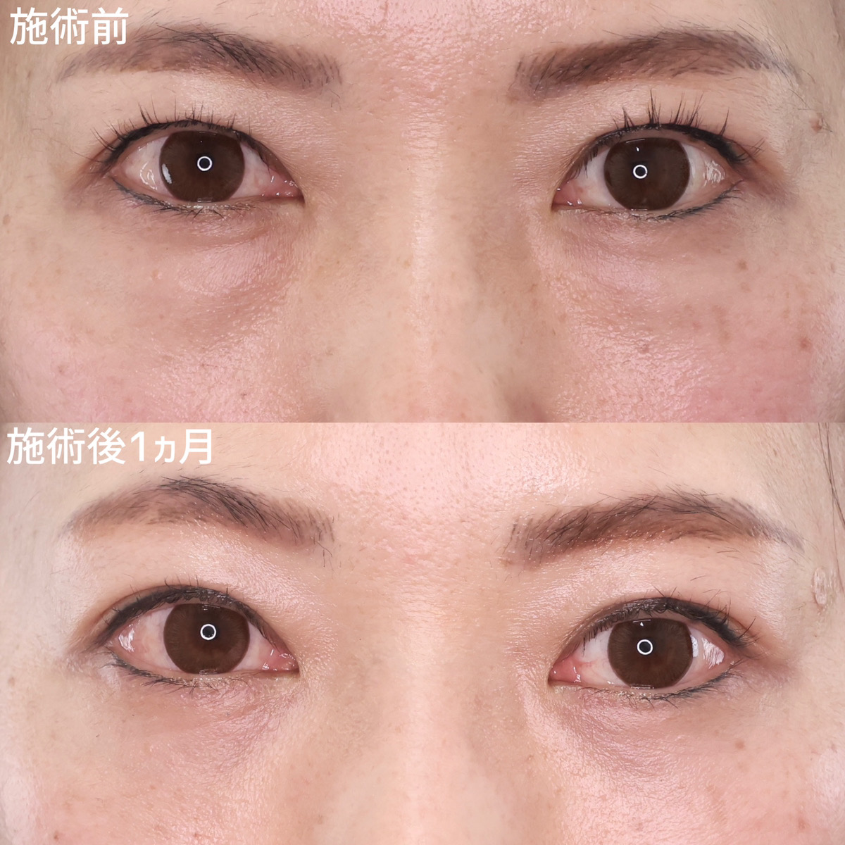 クマが老けてみる原因に！ふくらみを除去して明るいお目元へ