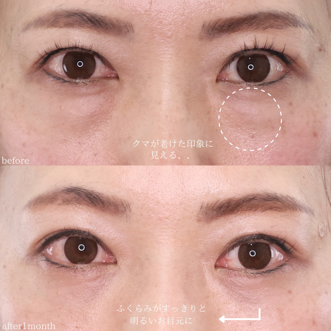 下眼瞼脱脂術（目の下のたるみ取り・目の下の脂肪ふくらみ取り）の症例写真 施術前後 