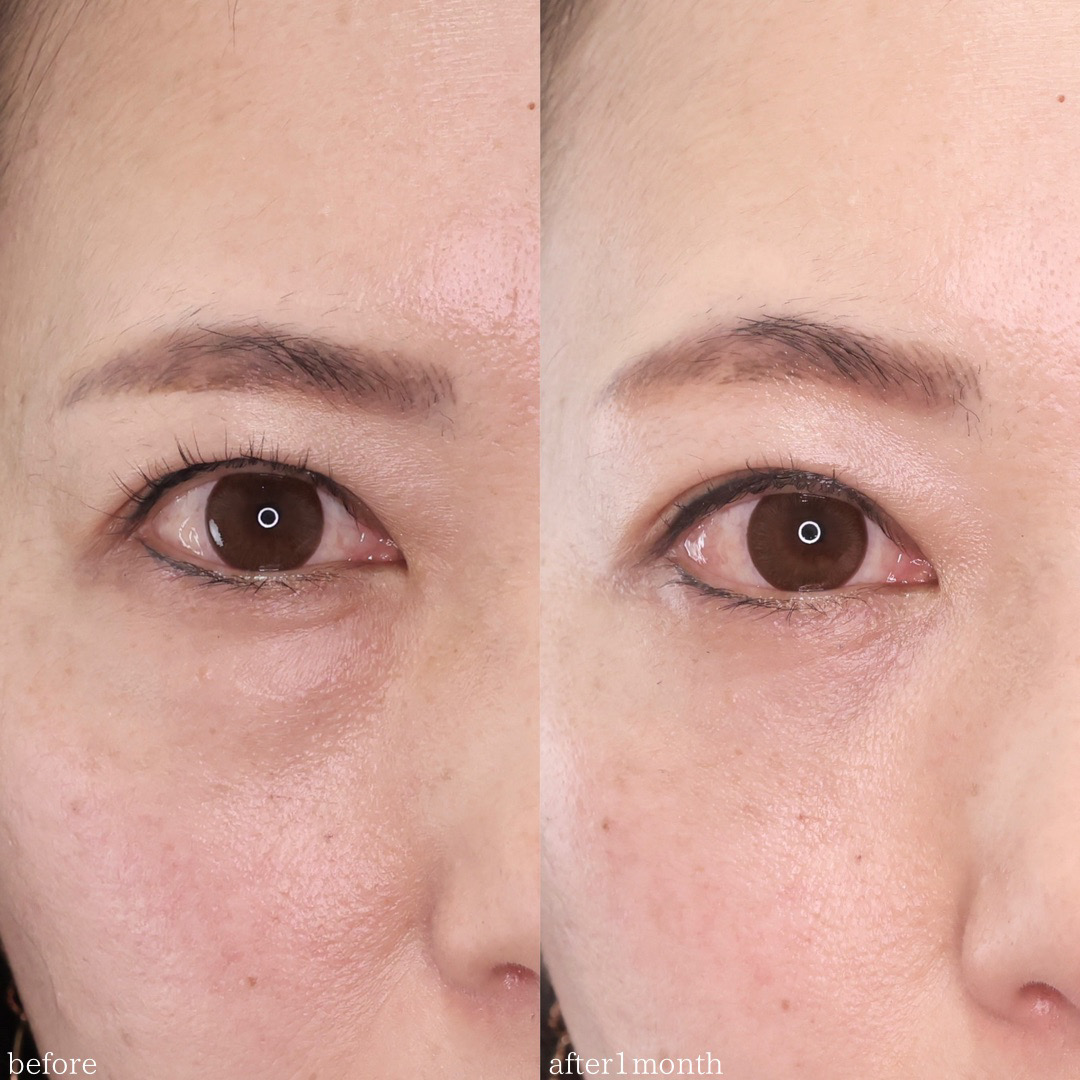 下眼瞼脱脂術（目の下のたるみ取り・目の下の脂肪ふくらみ取り）の症例写真 施術前後 