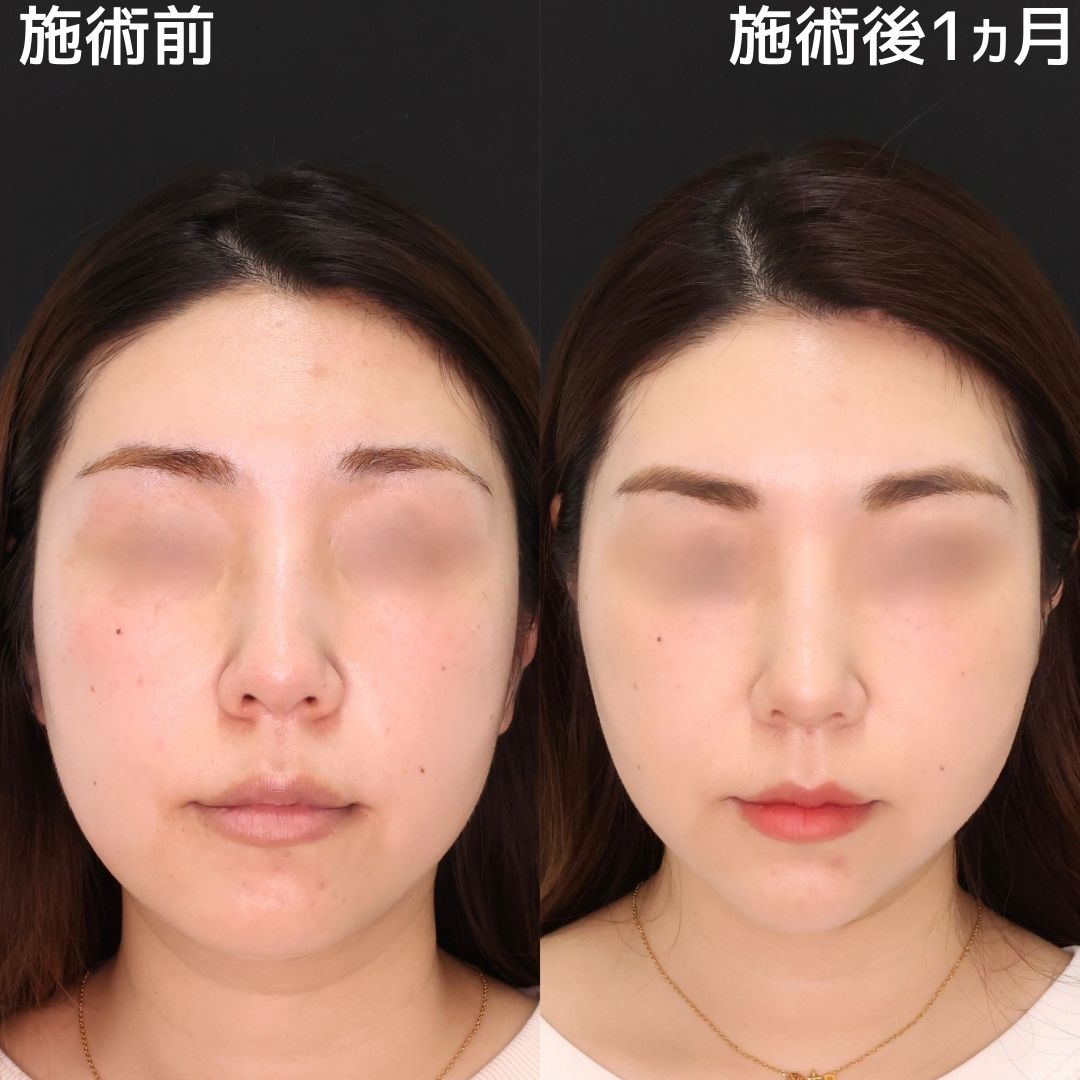 キュッと引き上がった小顔に！理想の卵型フェイス