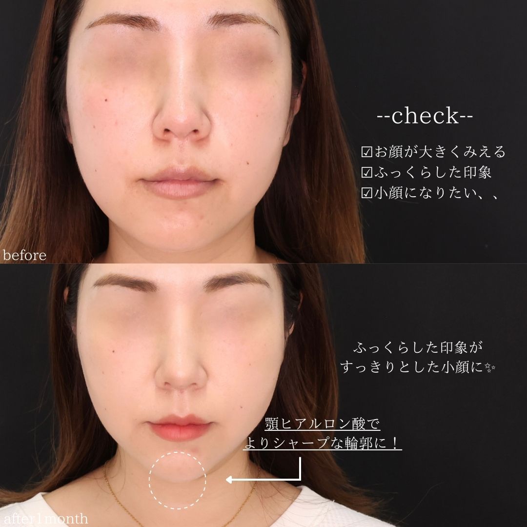 TAC式 ツヤ肌コラーゲンリフト®/顎のヒアルロン酸注射/エラボトックス注射の症例写真 施術前後 