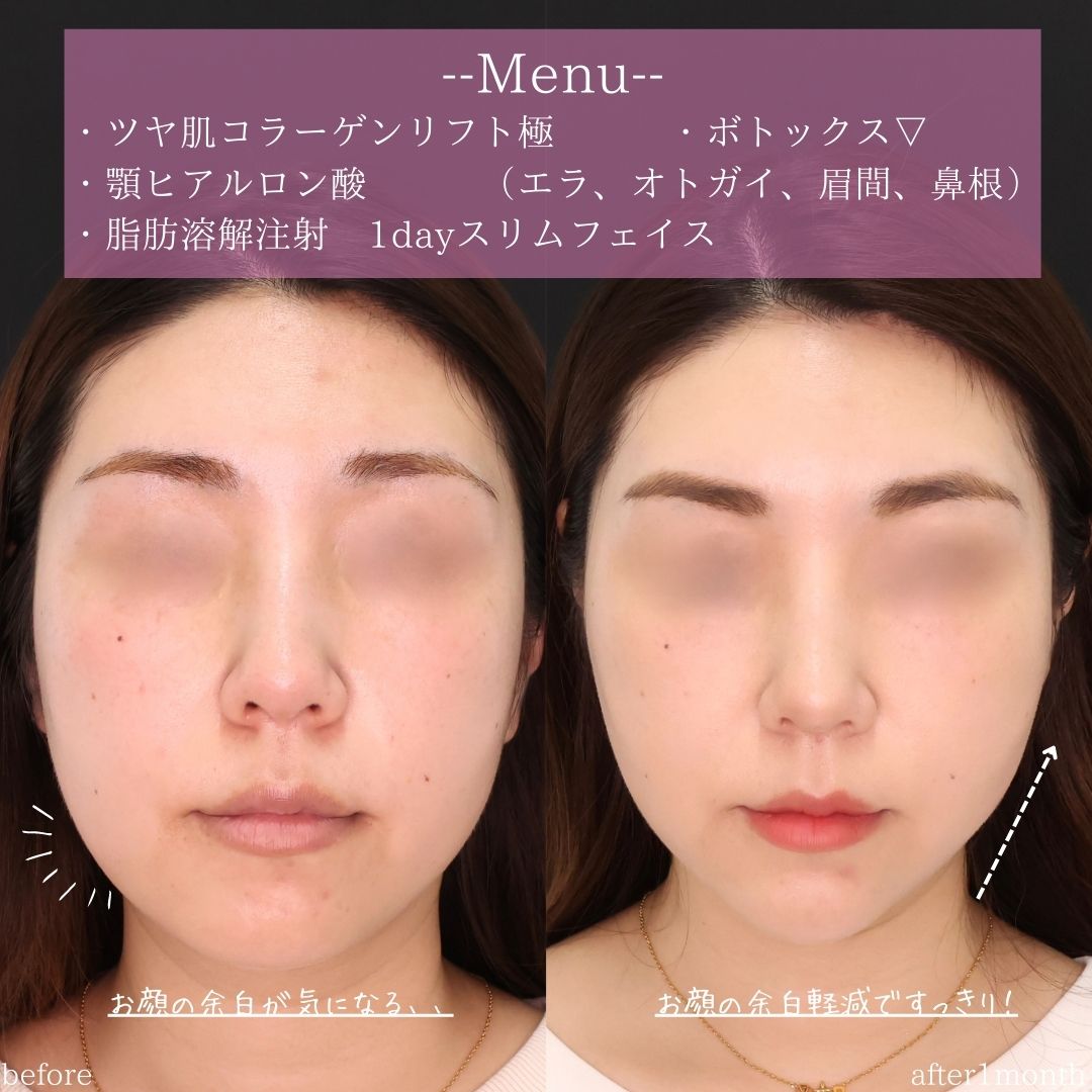 TAC式 ツヤ肌コラーゲンリフト®/顎のヒアルロン酸注射/エラボトックス注射の症例写真 施術前後 