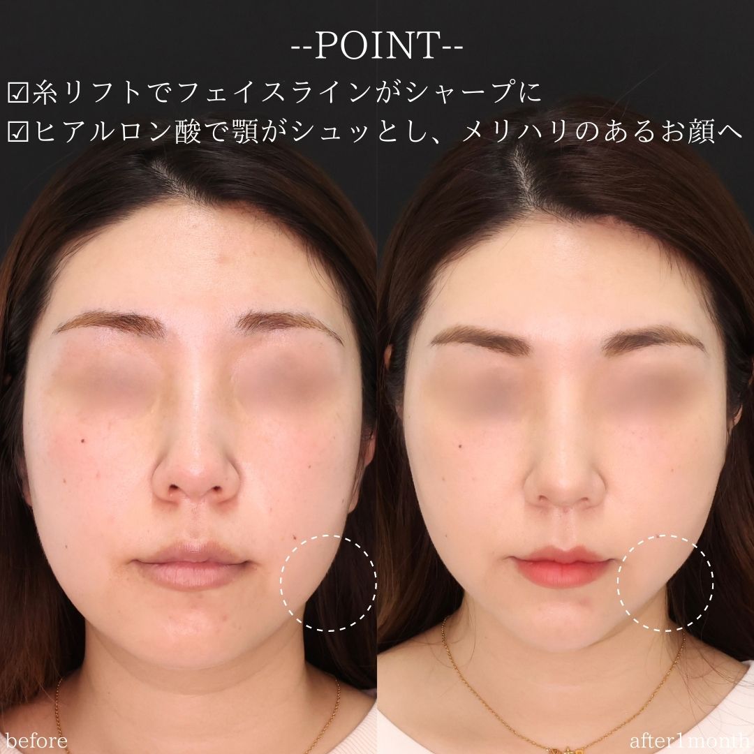 TAC式 ツヤ肌コラーゲンリフト®/顎のヒアルロン酸注射/エラボトックス注射の症例写真 施術前後 