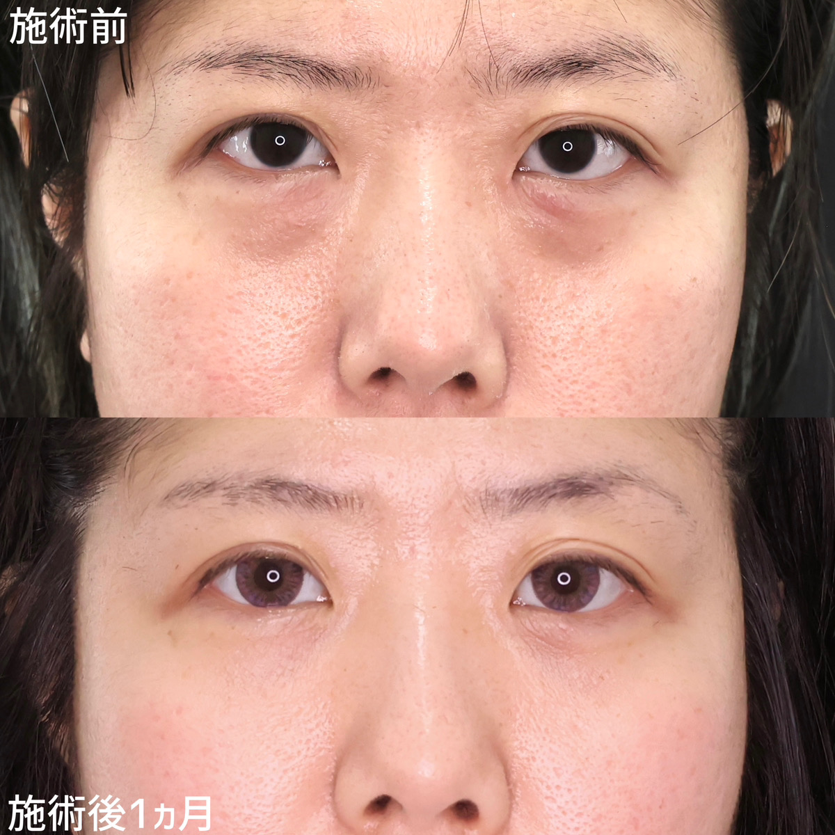 クマとりで若々しいお目元に！