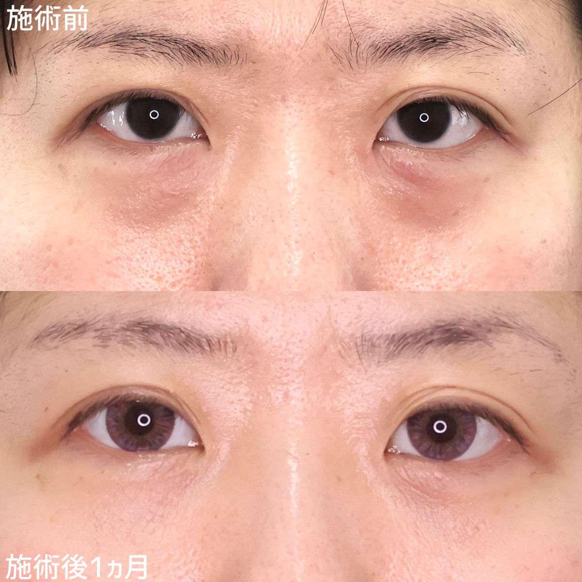 下眼瞼脱脂術(目の下のたるみ取り・目の下の脂肪ふくらみ取り)の症例写真 施術前後