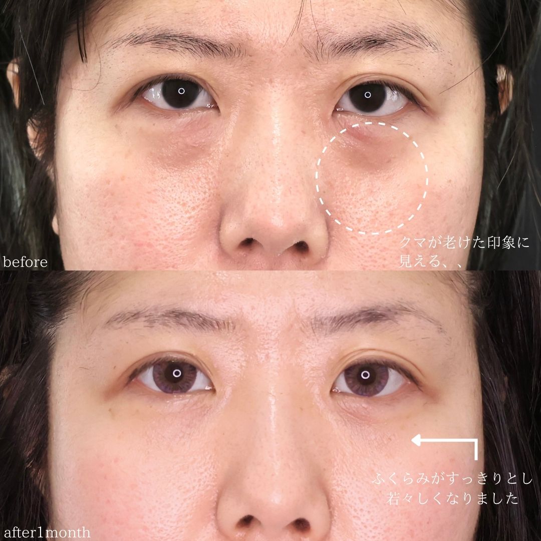 下眼瞼脱脂術(目の下のたるみ取り・目の下の脂肪ふくらみ取り)の症例写真 施術前後