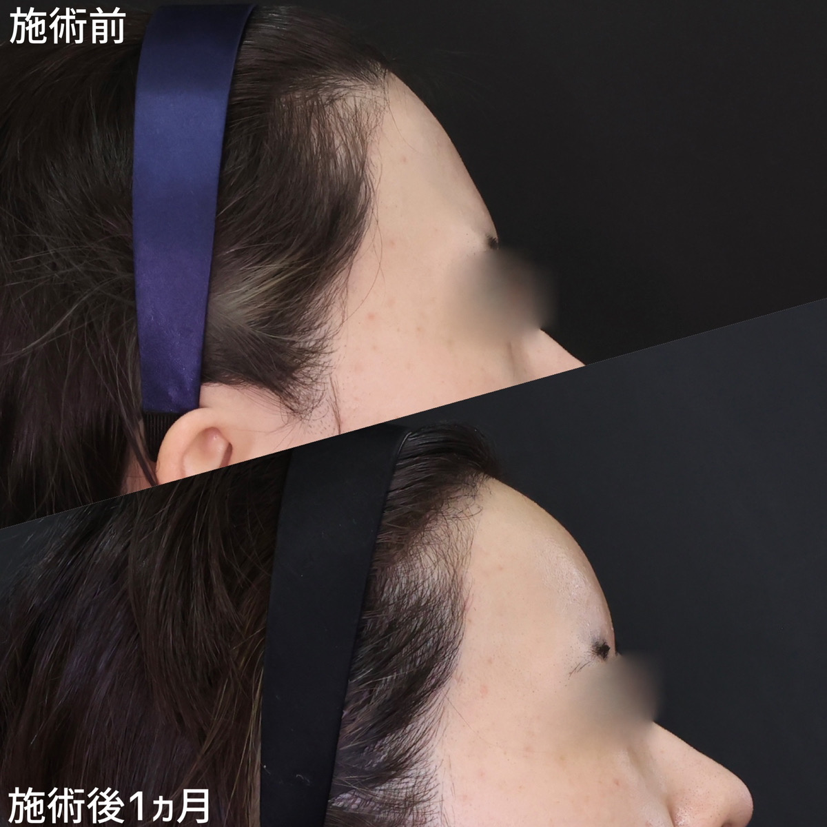 女性らしい丸みのあるおでこで美人度up！