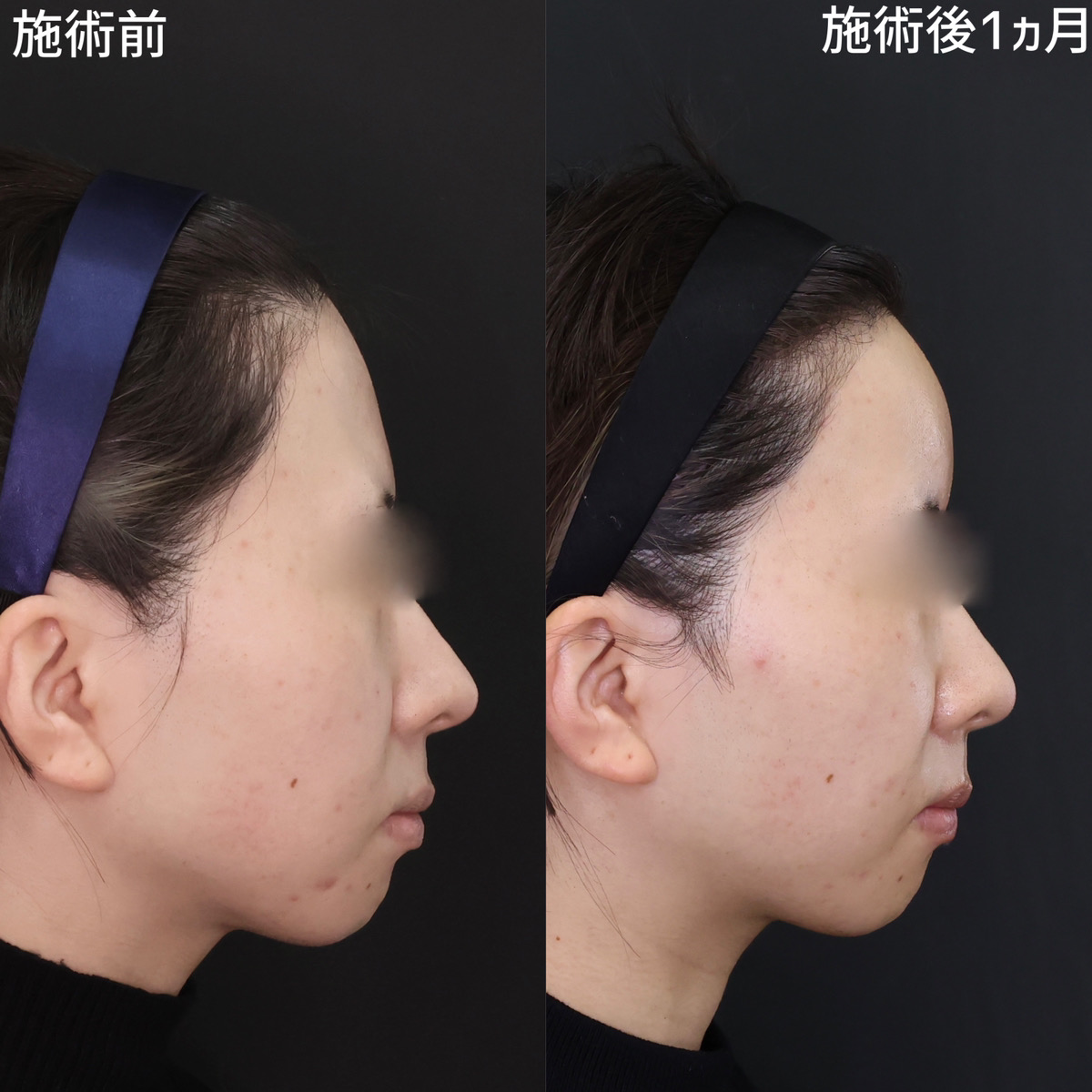 おでこの脂肪注入（オルチャンデコ形成）/顔の脂肪注入(コンデンスリッチフェイス)の症例写真 施術前後 