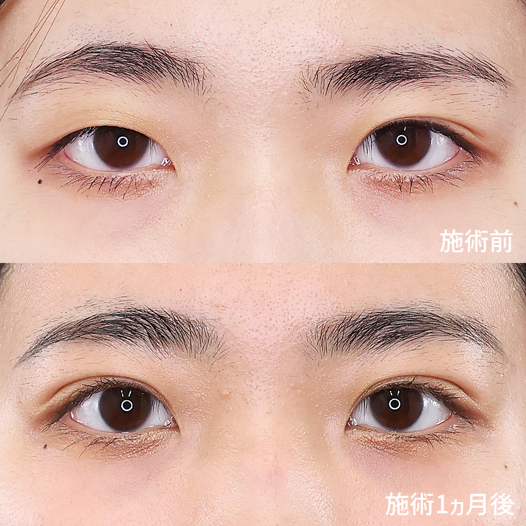 綺麗が持続するTAクリニックの【二重埋没法】で左右差を解消！！