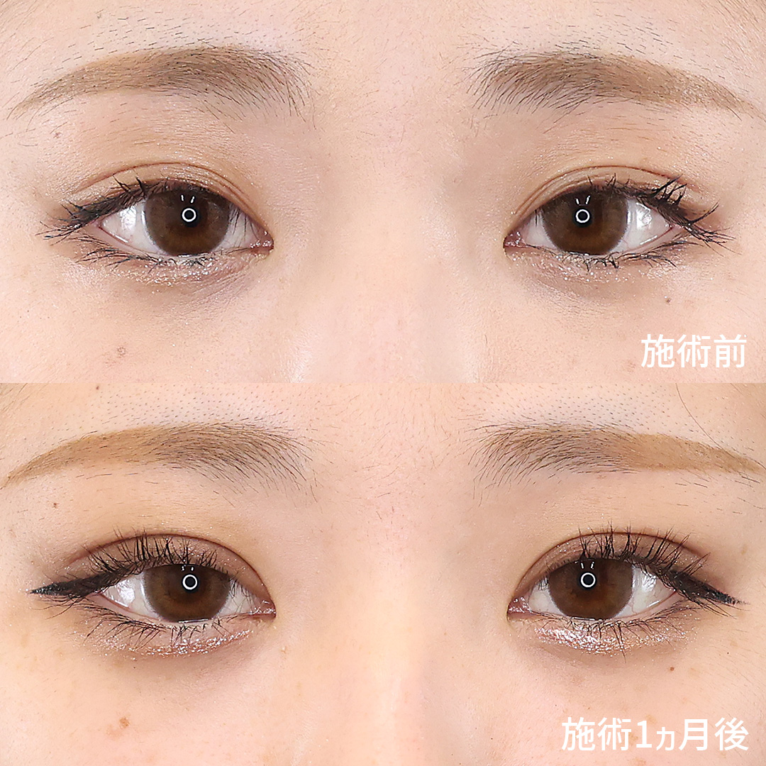 【二重埋没法】でしっかり強い二重ラインを形成。