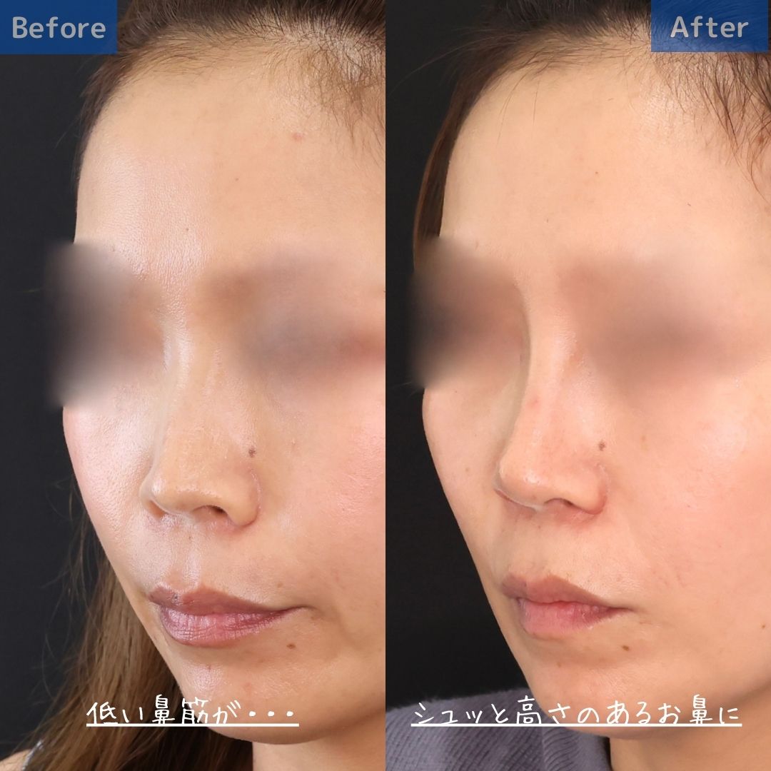 鼻孔縁挙上術/隆鼻術（プロテーゼ・自家組織）/鼻先軟骨移植の症例写真 施術前後 