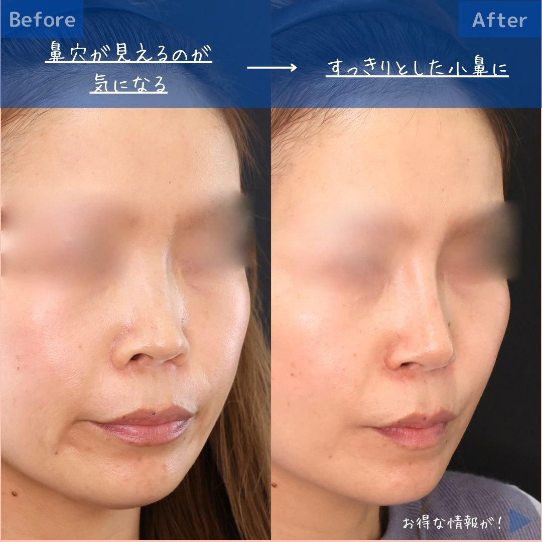 鼻孔縁挙上術/隆鼻術（プロテーゼ・自家組織）/鼻先軟骨移植の症例写真 施術前後 