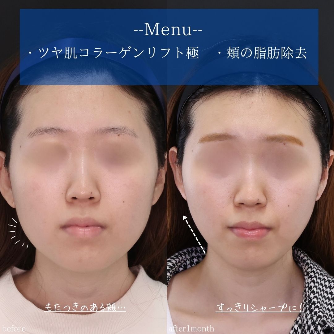 TAC式 ツヤ肌コラーゲンリフト®の症例写真 施術前後 
