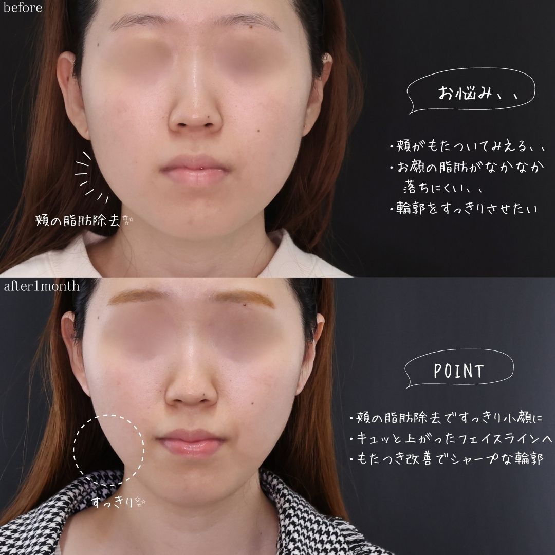 TAC式 ツヤ肌コラーゲンリフト®の症例写真 施術前後 