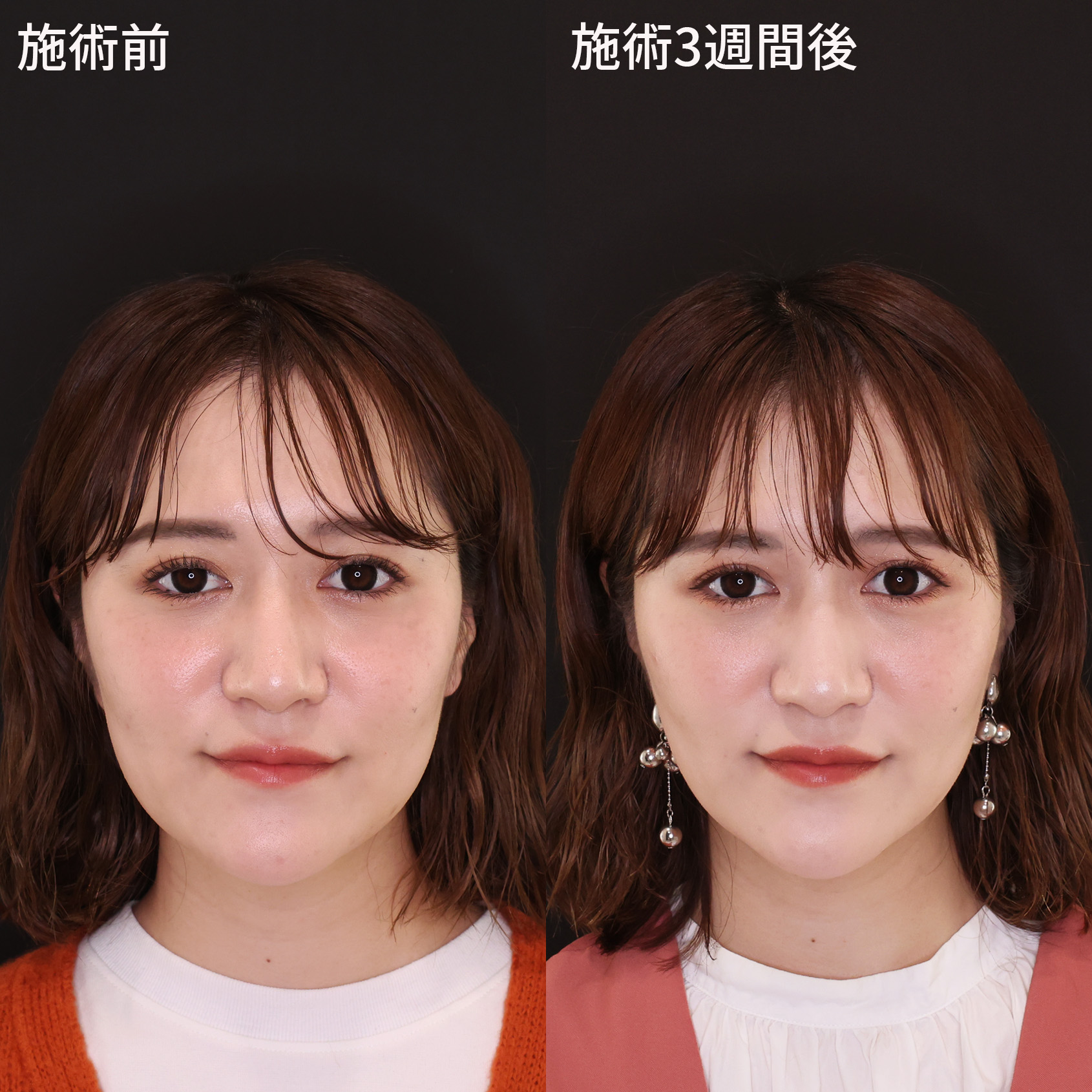 術直後から綺麗な卵型フェイス【糸リフト】