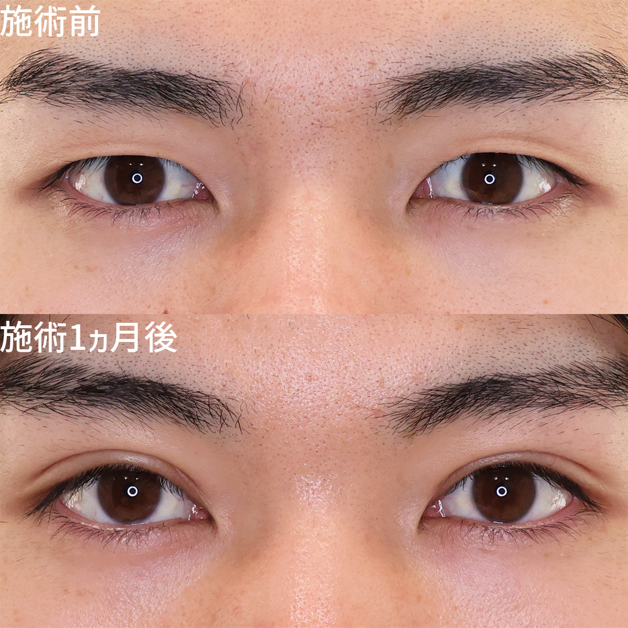 長年の悩みを解消！ぱっちり二重に！【二重埋没法】