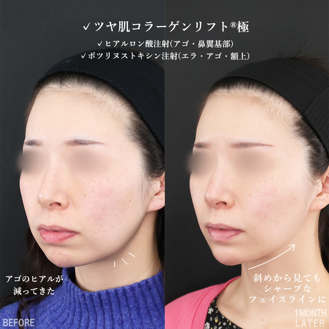 TAC式 ツヤ肌コラーゲンリフト®/ほうれい線のヒアルロン酸注射/顎のヒアルロン酸注射の症例写真 施術前後