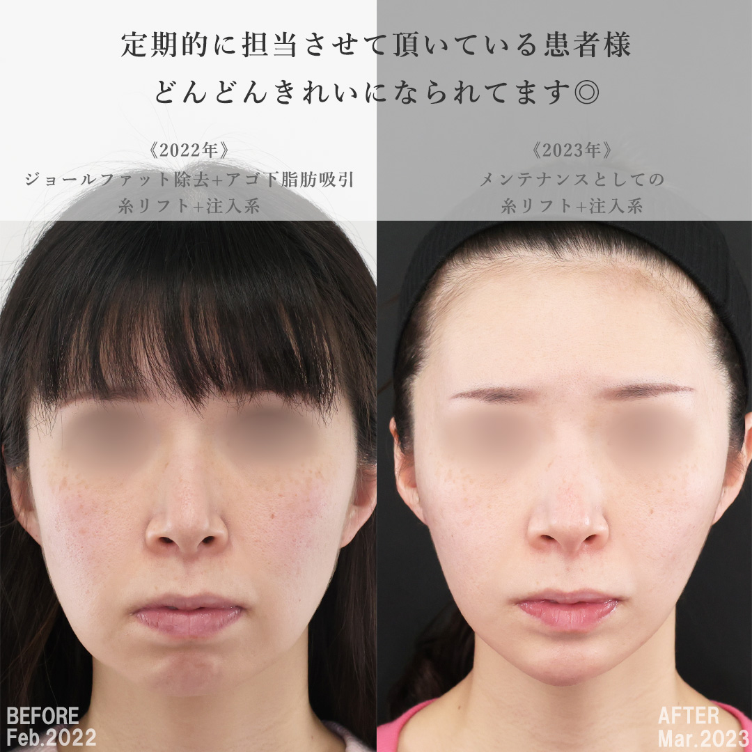 TAC式 ツヤ肌コラーゲンリフト®/ほうれい線のヒアルロン酸注射/顎のヒアルロン酸注射の症例写真 施術前後