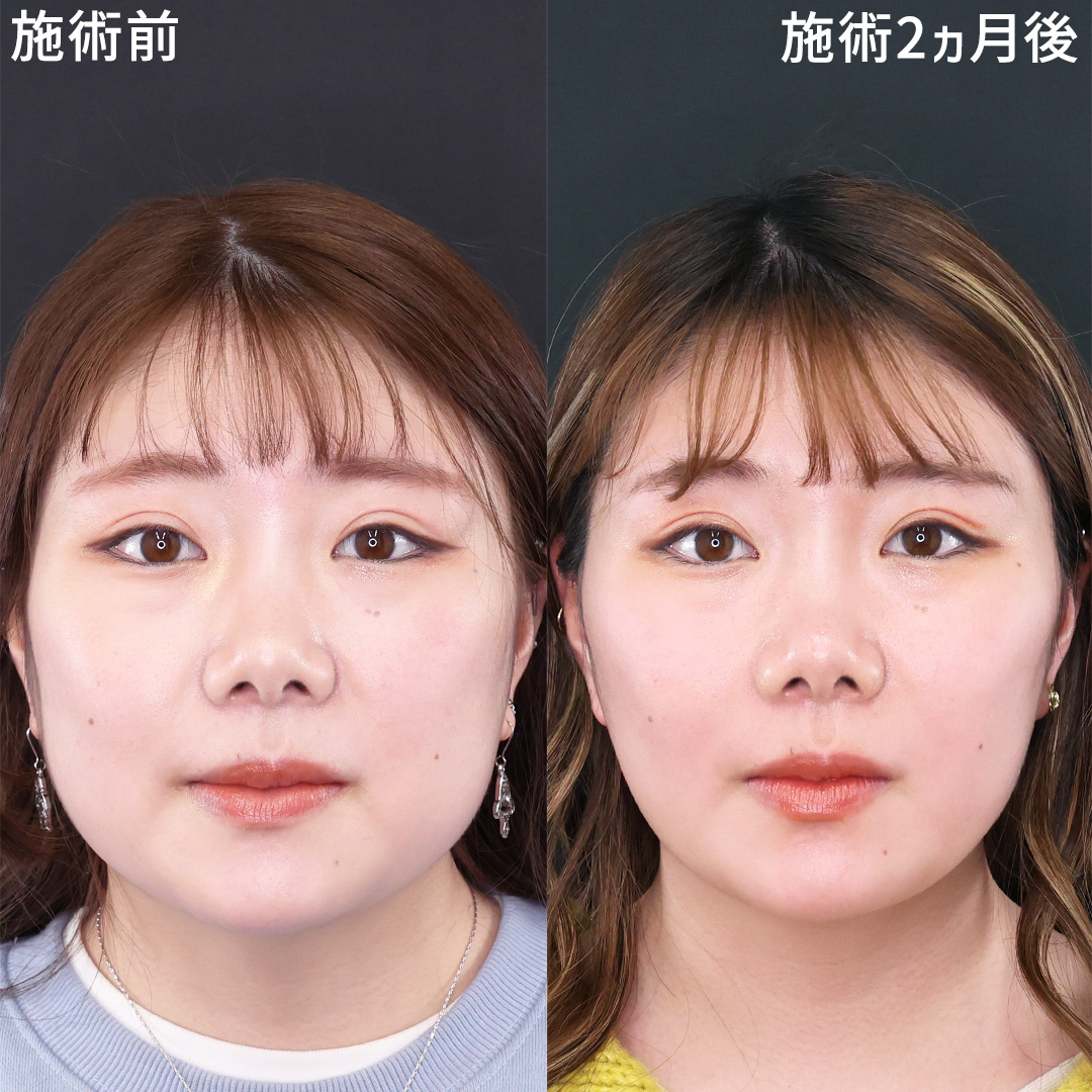 笑顔も一回り小さいフェイスラインに！！