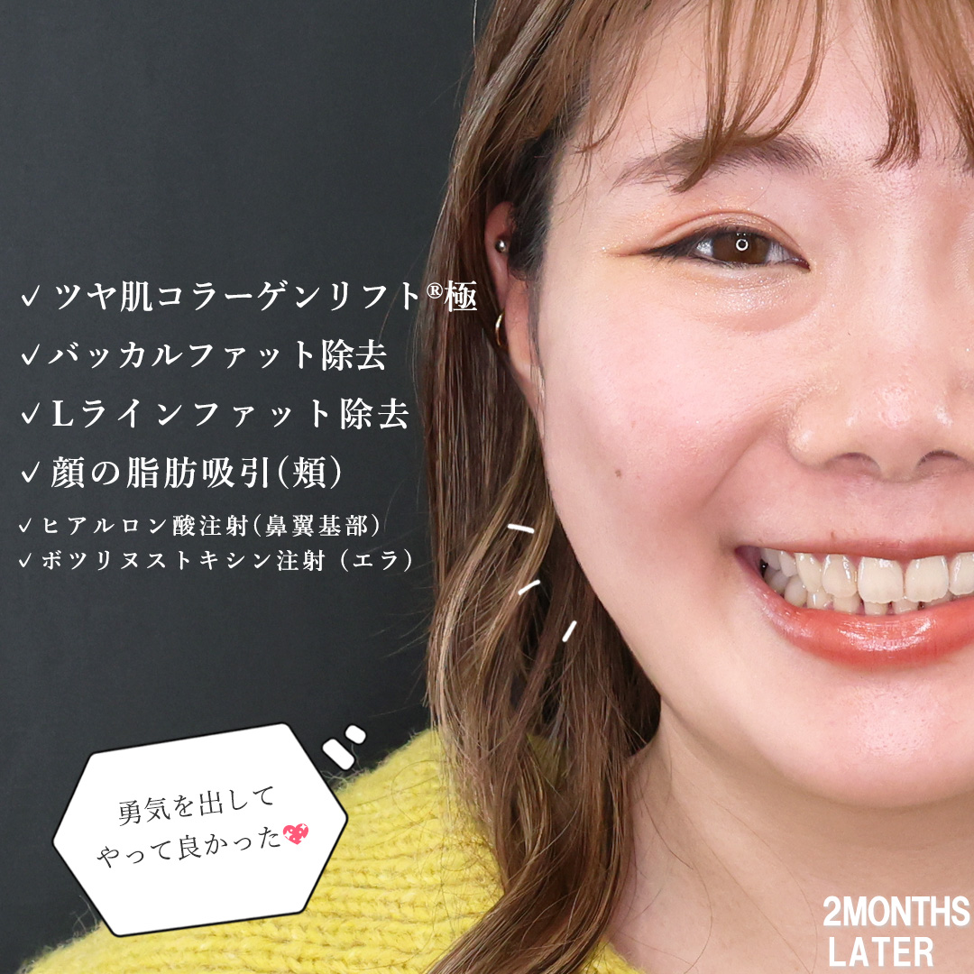 TAC式 ツヤ肌コラーゲンリフト®/バッカルファット除去/Lラインファット除去（エラ下脂肪除去）の症例写真 施術前後 