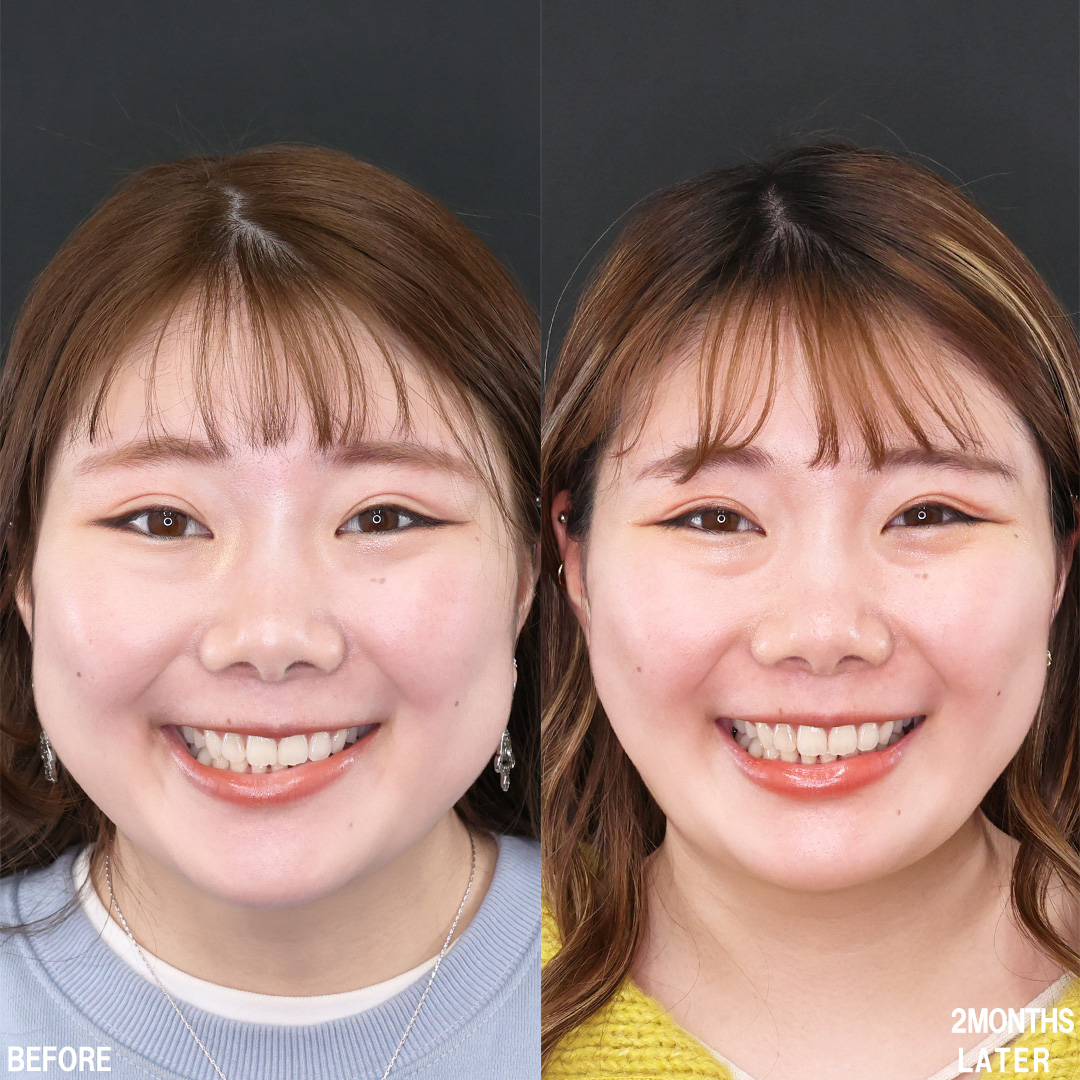 TAC式 ツヤ肌コラーゲンリフト®/バッカルファット除去/Lラインファット除去（エラ下脂肪除去）の症例写真 施術前後 