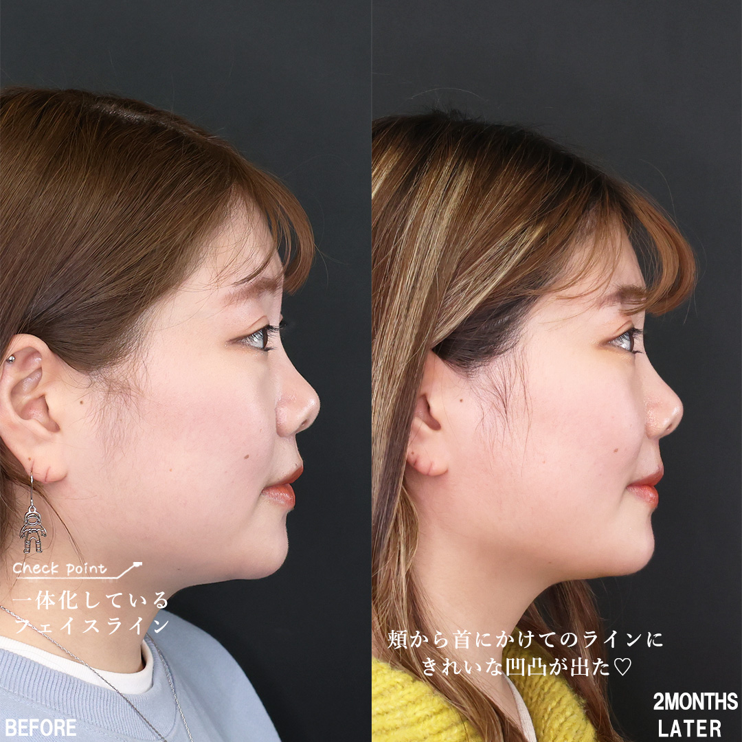 TAC式 ツヤ肌コラーゲンリフト®/バッカルファット除去/Lラインファット除去（エラ下脂肪除去）の症例写真 施術前後 