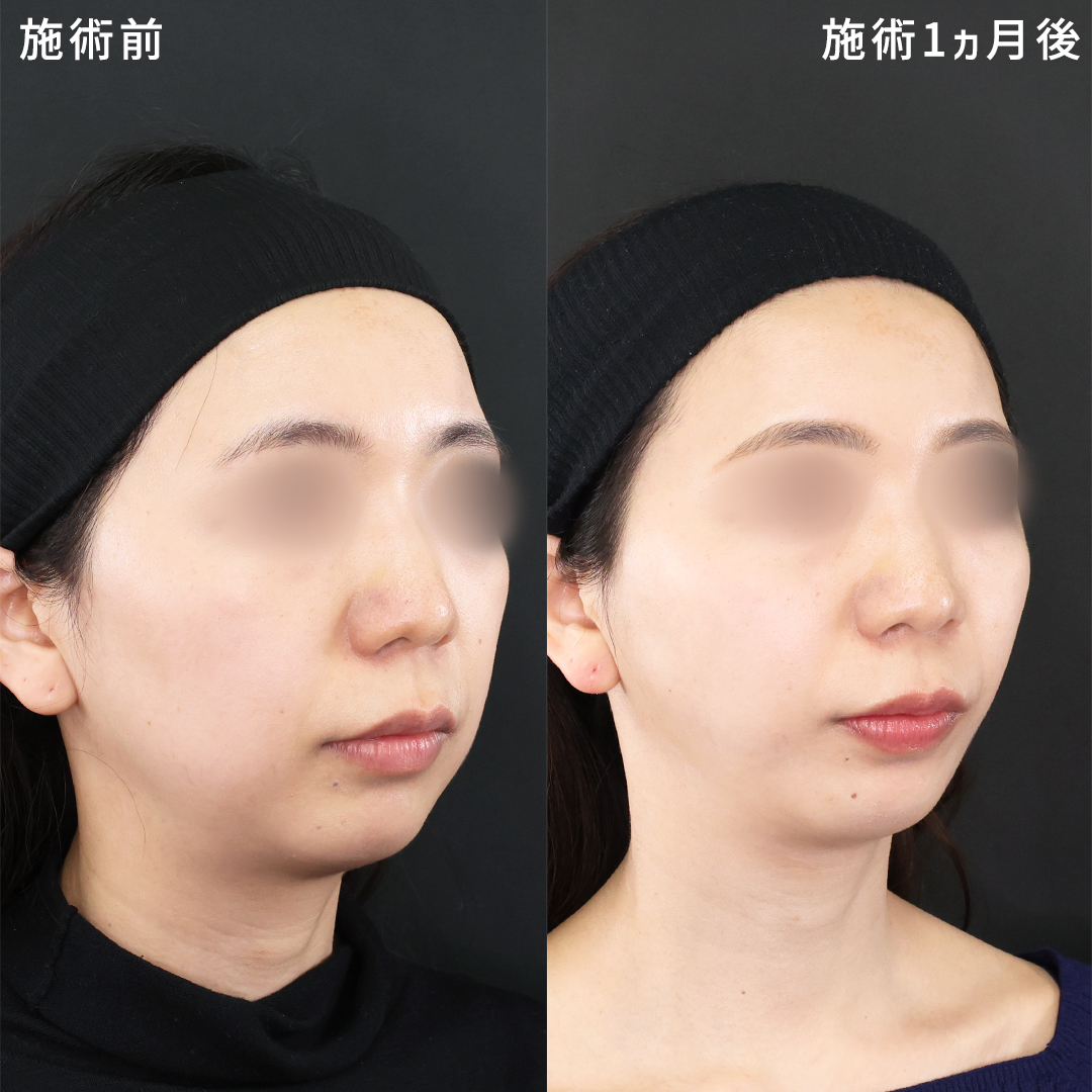 【丸顔改善】すっきとした小顔に！