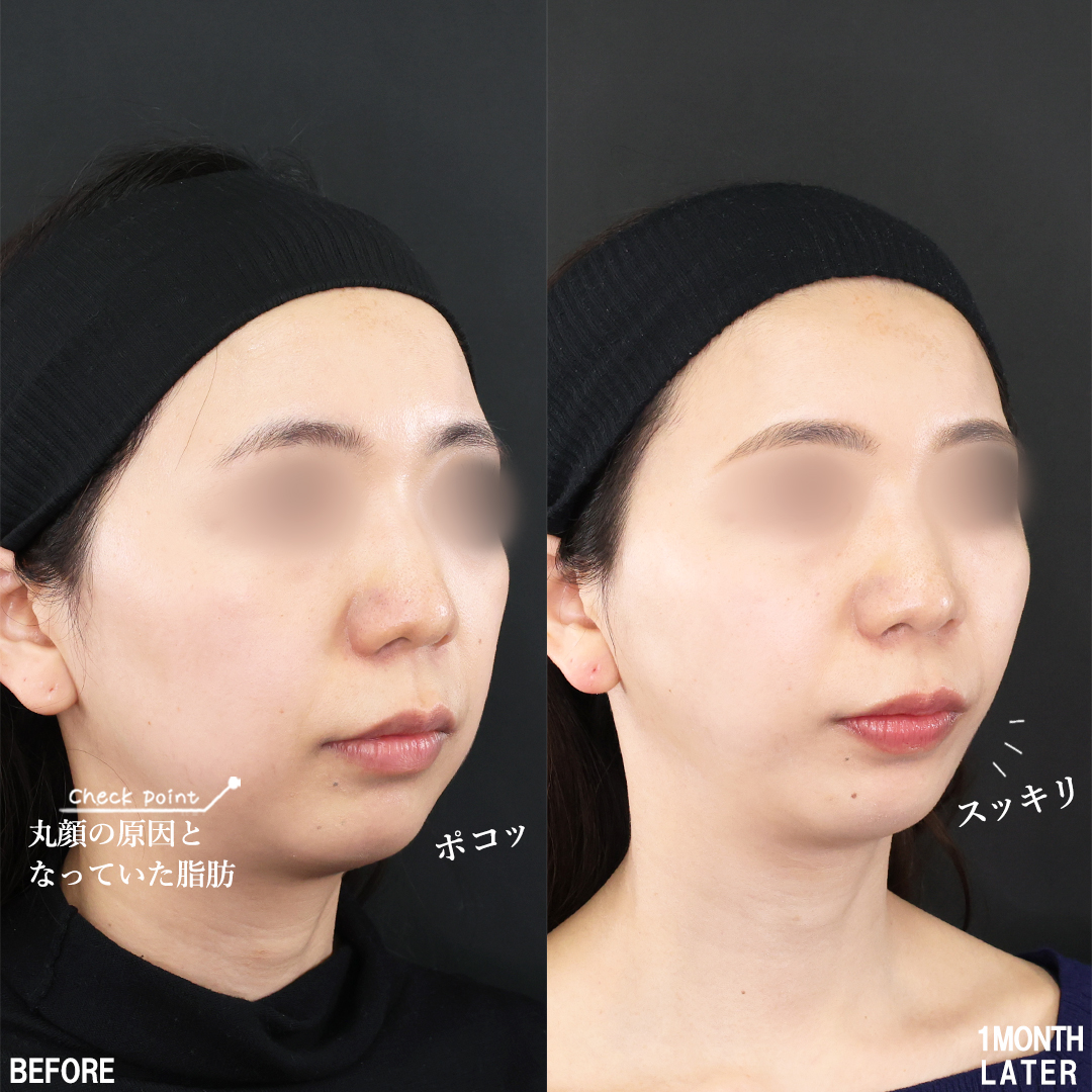 TAC式 ツヤ肌コラーゲンリフト®/Lラインファット除去(エラ下脂肪除去)/顔の脂肪吸引の症例写真 施術前後