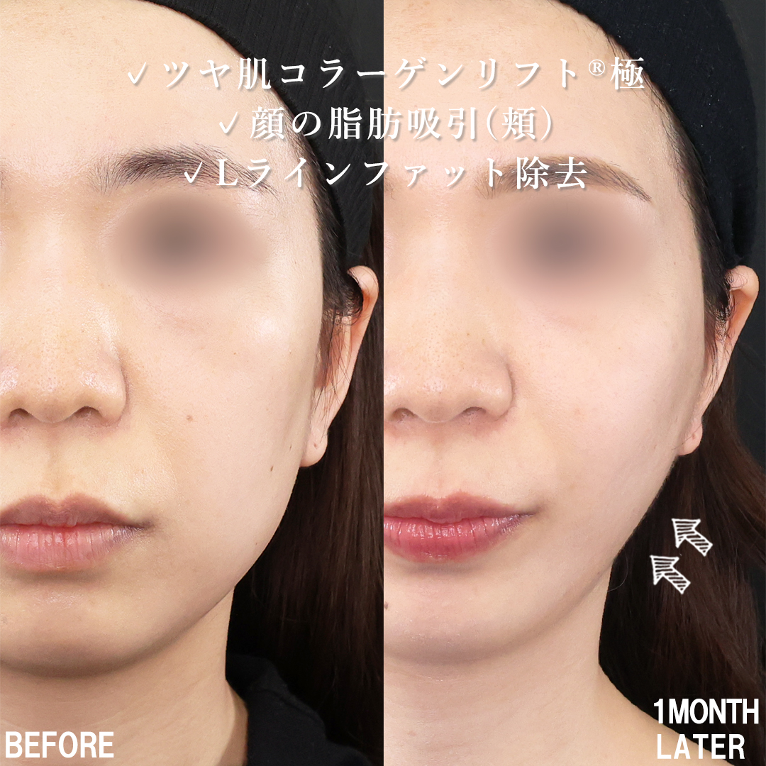 TAC式 ツヤ肌コラーゲンリフト®/Lラインファット除去(エラ下脂肪除去)/顔の脂肪吸引の症例写真 施術前後