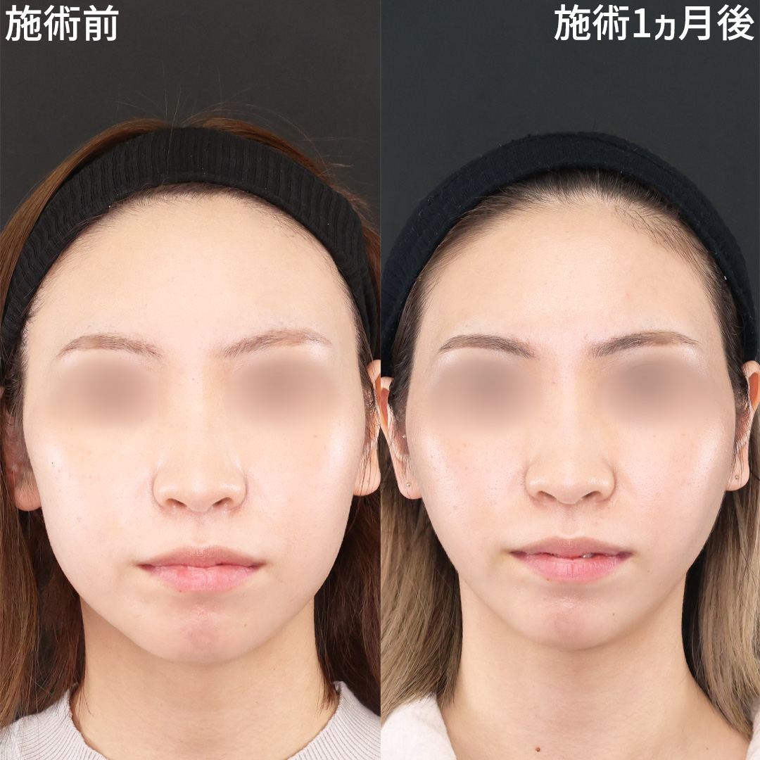 パーフェクトフェイスラインで理想の卵型に◎