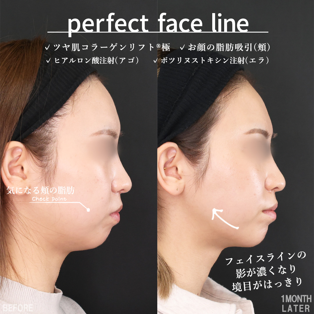 小顔整形｜パーフェクトフェイスライン/TAC式 ツヤ肌コラーゲンリフト®/顔の脂肪吸引の症例写真 施術前後 