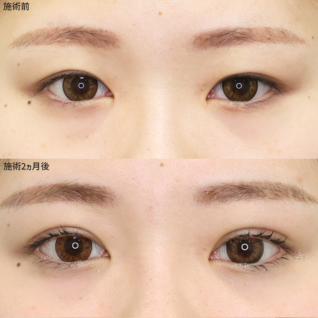 【埋没法】切開術なしで叶える理想の二重