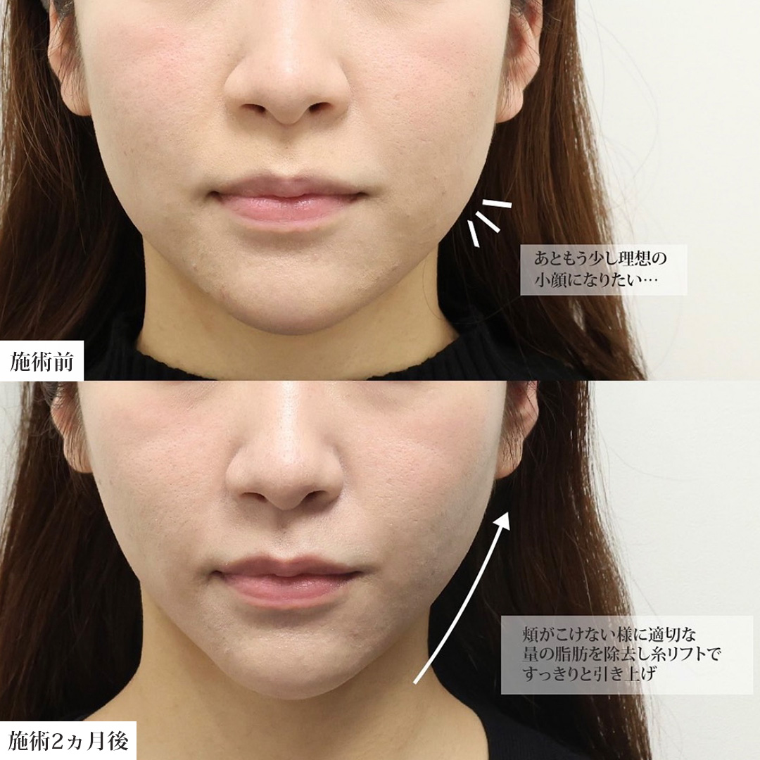 TAC式 ツヤ肌コラーゲンリフト®/バッカルファット除去/ジョールファット除去の症例写真 施術前後