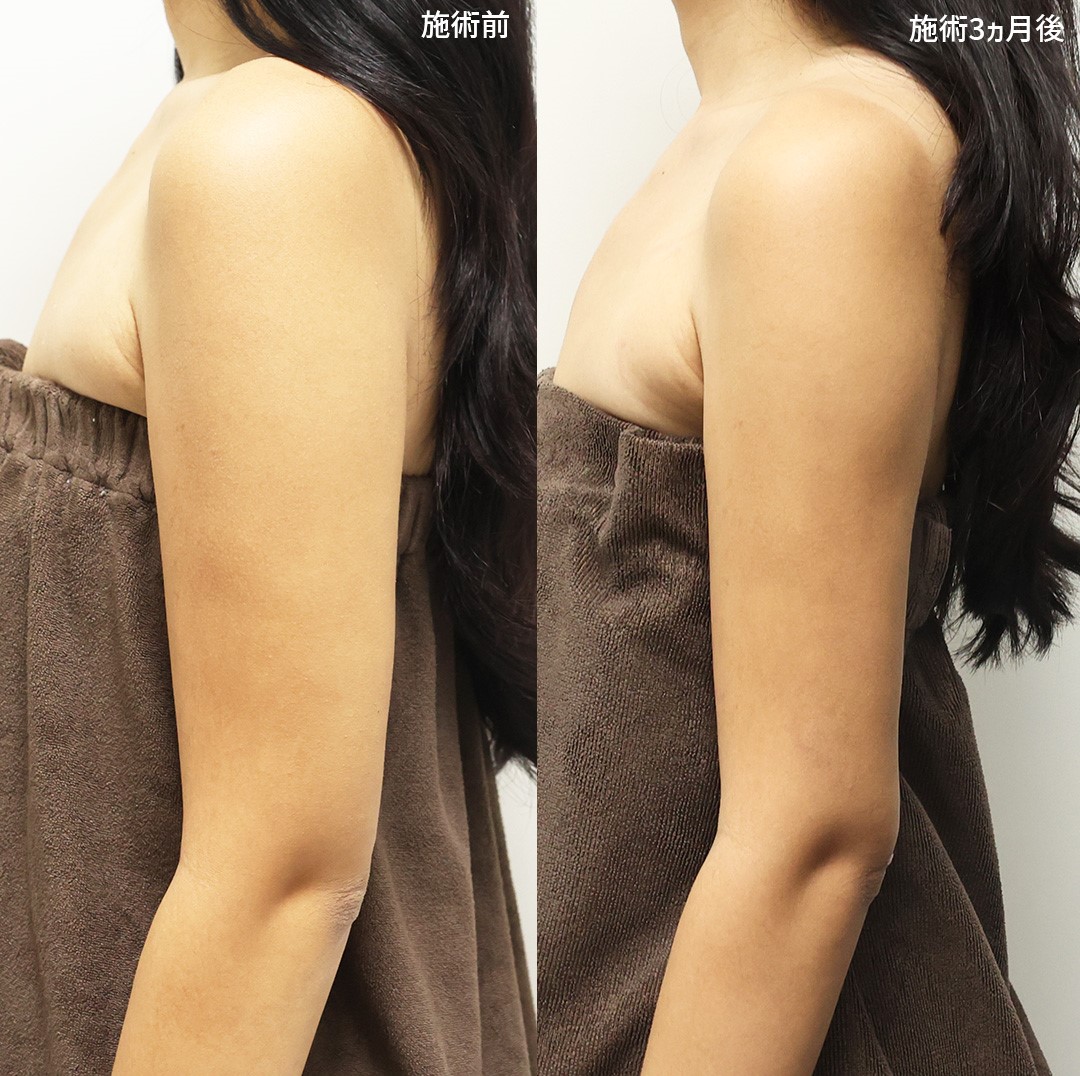 【脂肪吸引】で憧れのすっきり二の腕