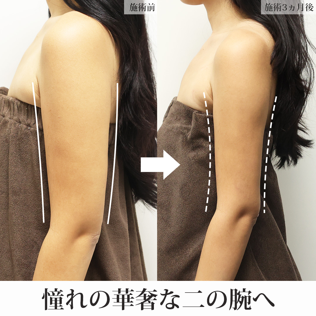 体の脂肪吸引の症例写真 施術前後 