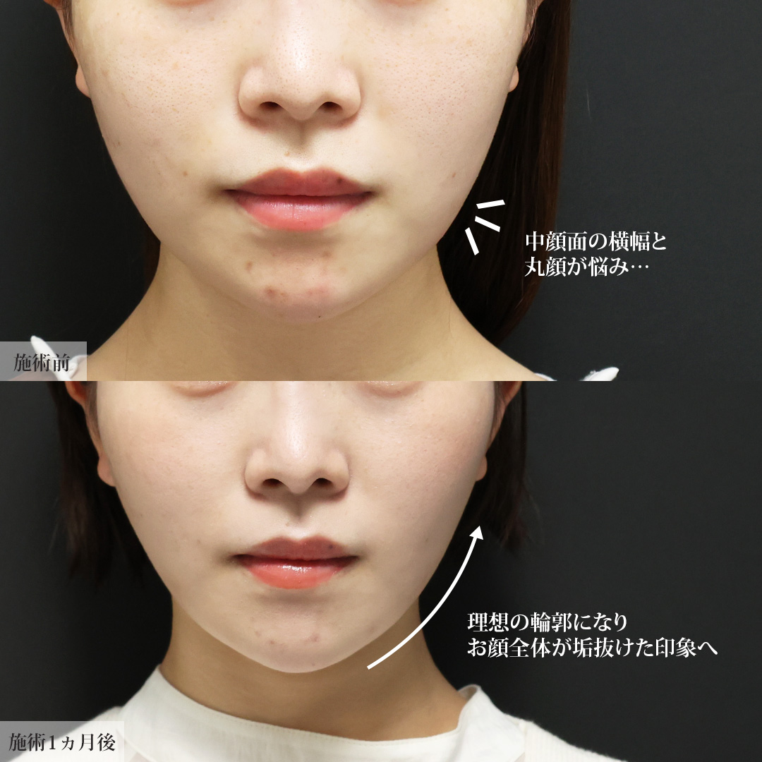 TAC式 ツヤ肌コラーゲンリフト®/バッカルファット除去/ジョールファット除去の症例写真 施術前後