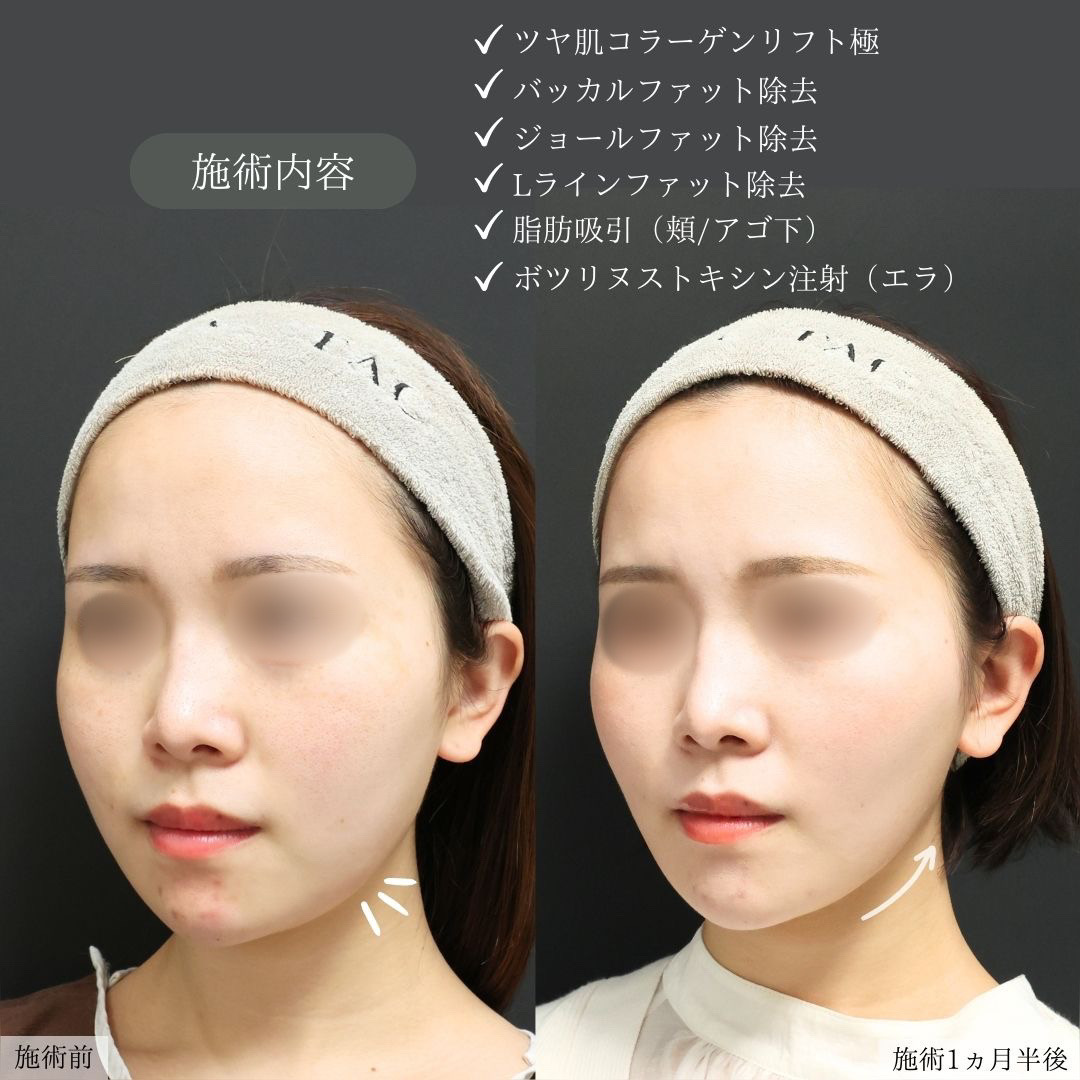TAC式 ツヤ肌コラーゲンリフト®/バッカルファット除去/ジョールファット除去の症例写真 施術前後