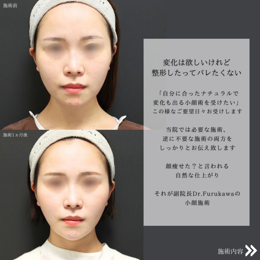 TAC式 ツヤ肌コラーゲンリフト®/バッカルファット除去/ジョールファット除去の症例写真 施術前後