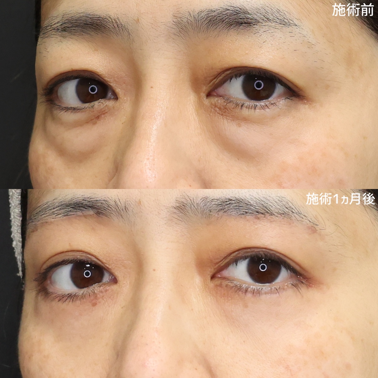 【クマ取り×眉下リフト】で明るく若々しい目元へ