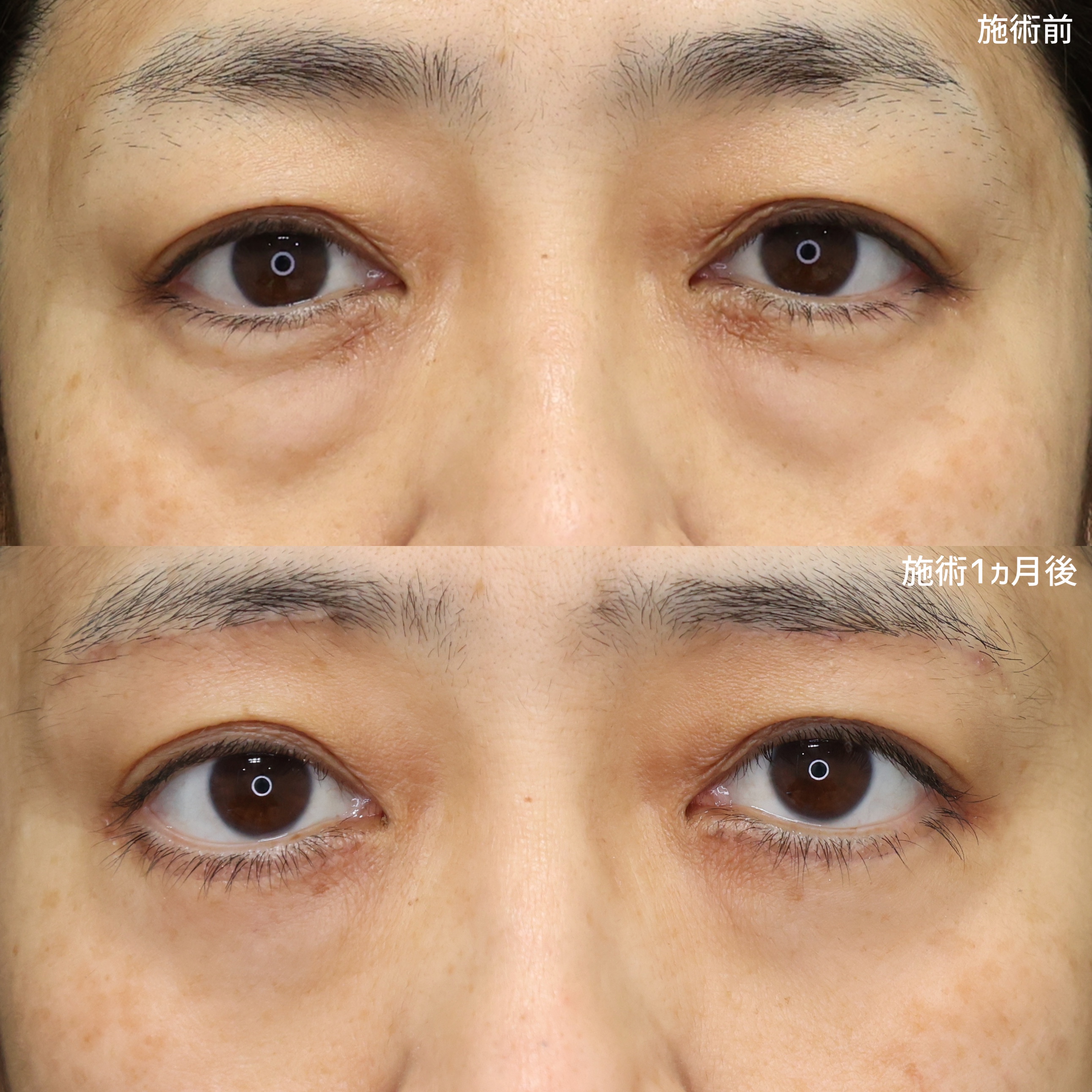 下眼瞼切開術（クマ・たるみとり）/眉毛下切開術/下眼瞼脱脂術（目の下のたるみ取り・目の下の脂肪ふくらみ取り）の症例写真 施術前後 
