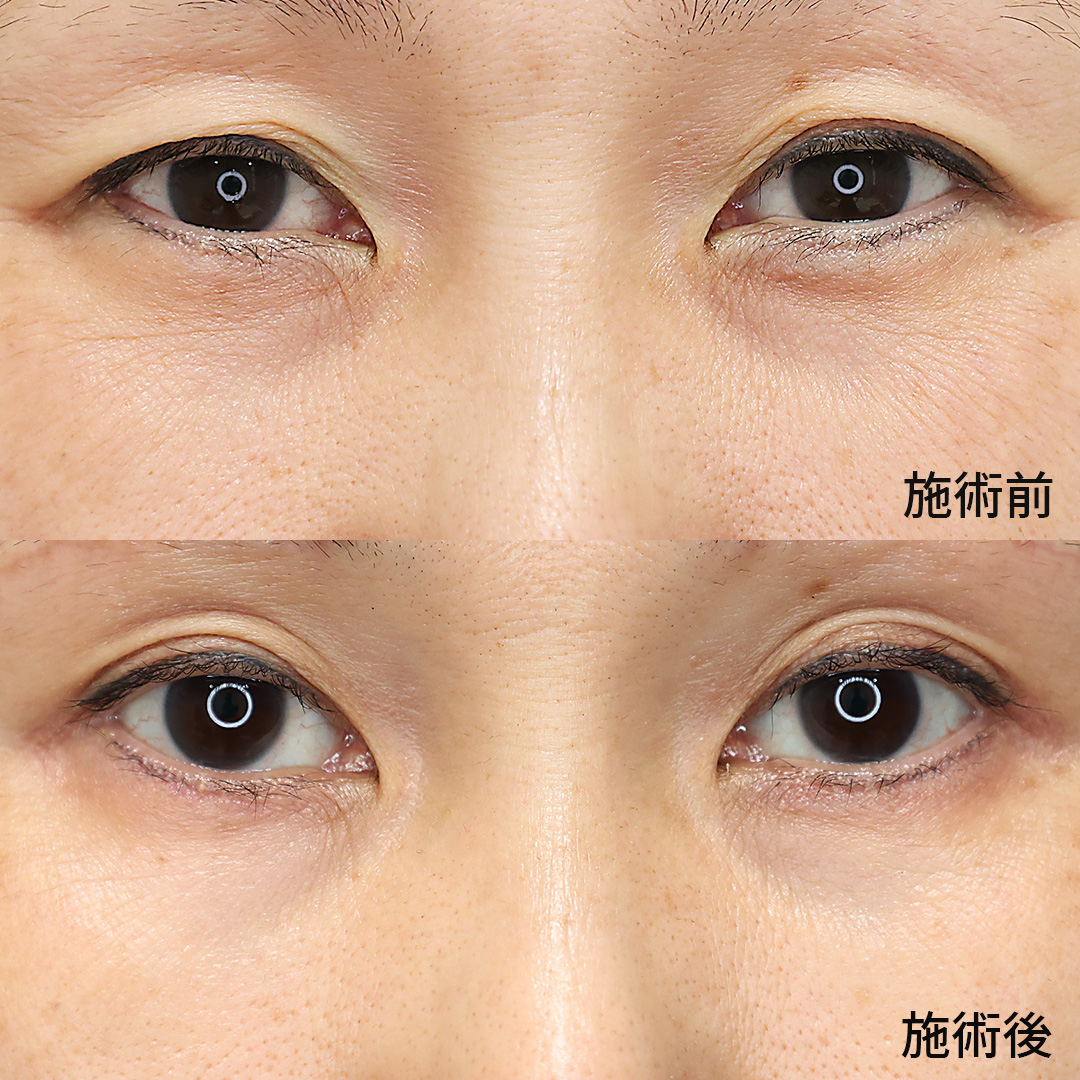 【スネコス注射】で小ジワを改善！年齢を感じさせない美しい肌へ。