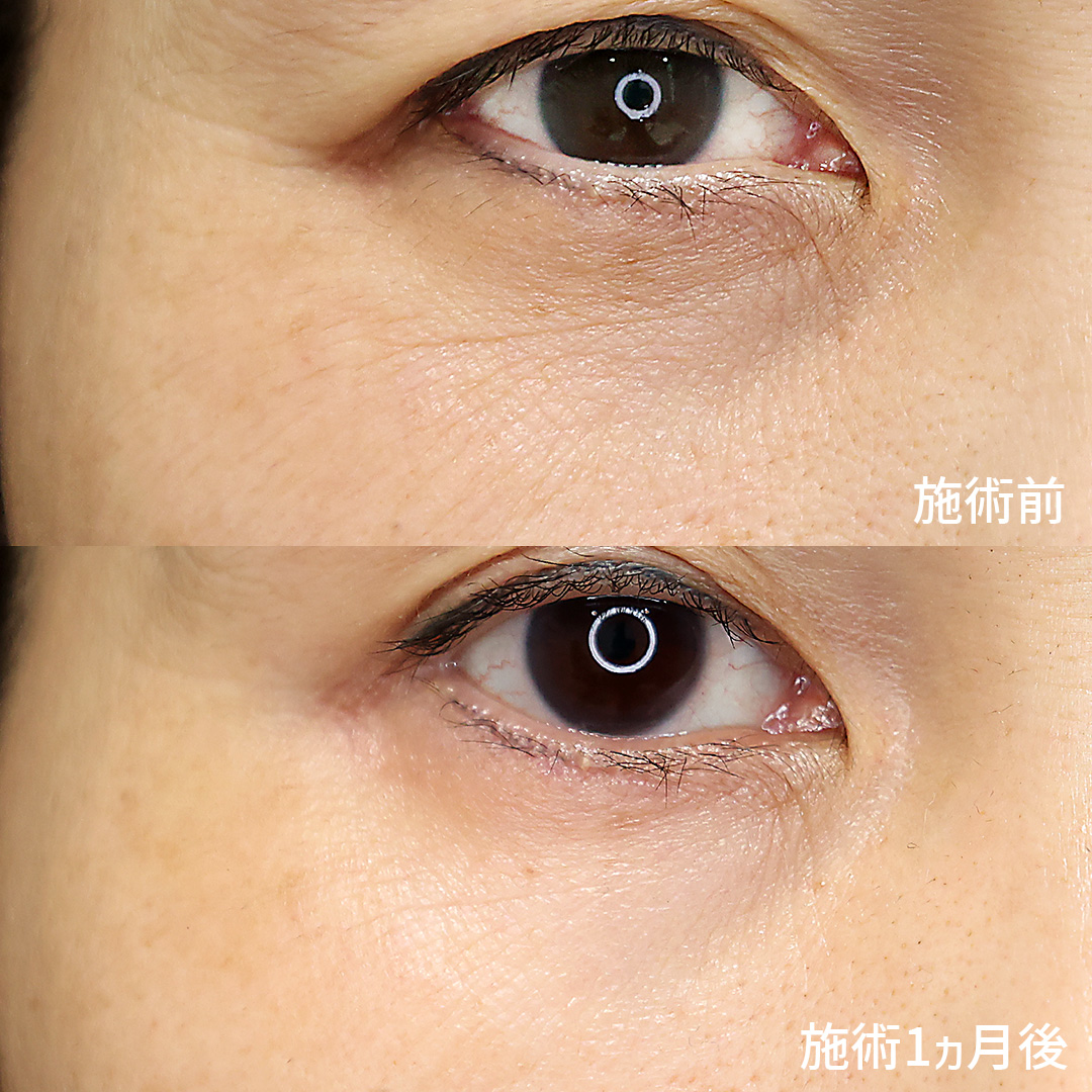 注射・プチ整形：その他の症例写真 施術前後 