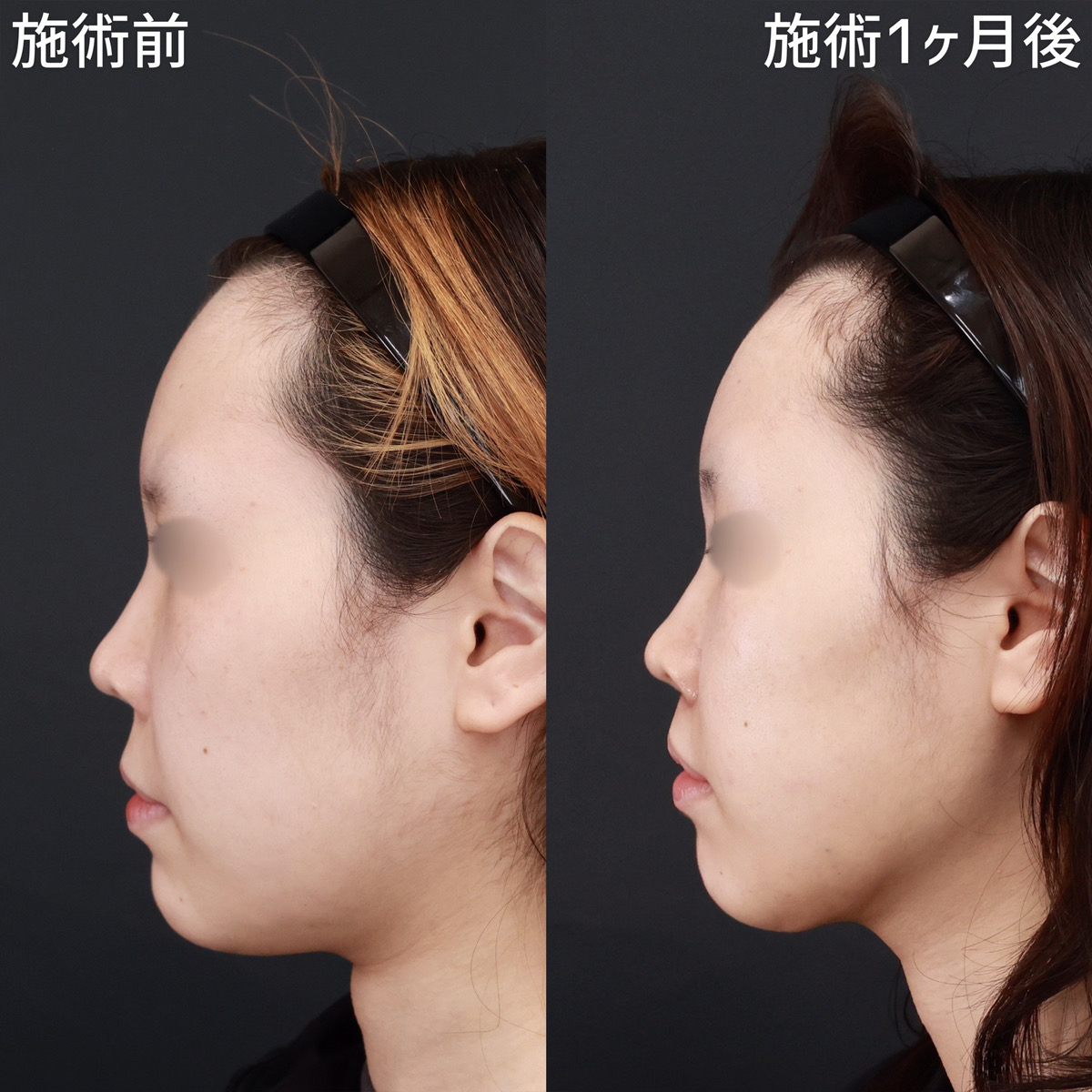 TAC式 ツヤ肌コラーゲンリフト®/顔の脂肪吸引/人中短縮術(リップリフト)・外側人中短縮術の症例写真 施術前後